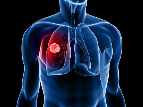 Lung cancer drug poised for global approval, says MWC investigator