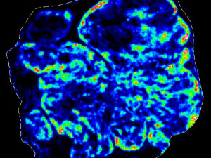 Cancer drug advances to phase II clinical trials