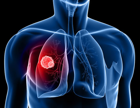 New Zealand patients trial local cancer drug (2012)