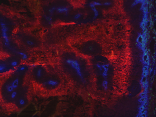 New drug targets treatment-resistant cancer (2011)