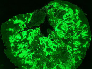 Cancer stealth drug enters clinical development (2010)